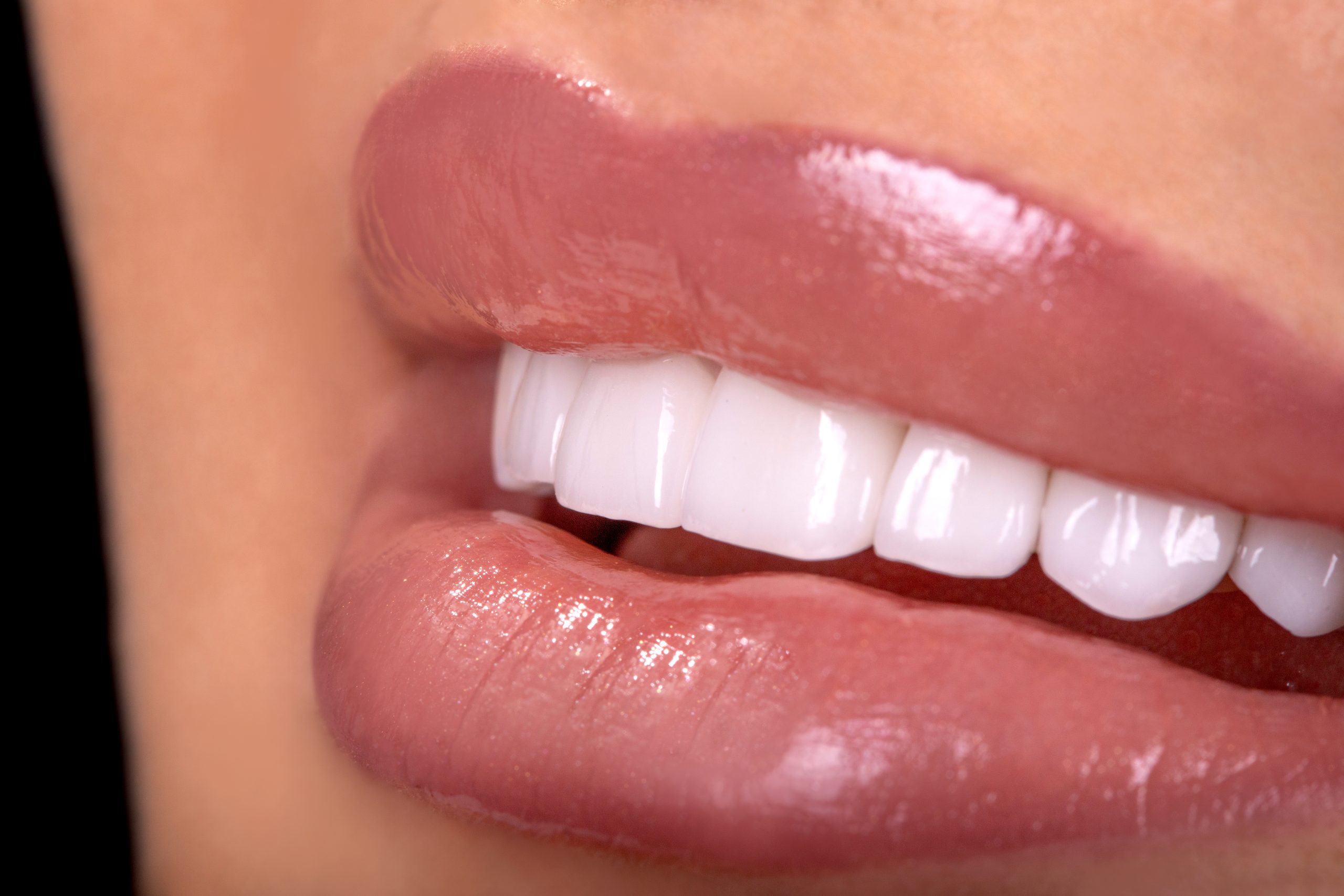 lip fiillers